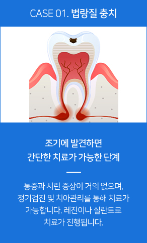 법랑질 충치