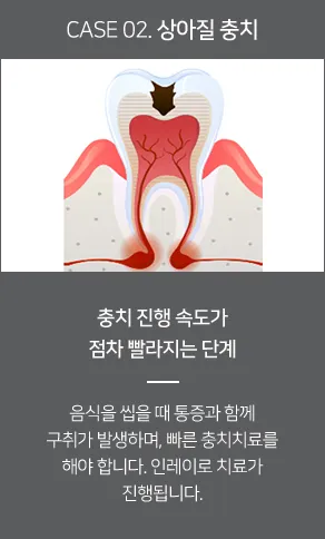 상아질 충치
