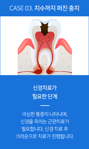 치수까지 퍼진 충치