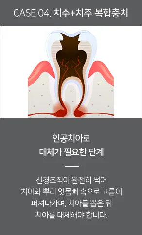 치수+치주 복합충치