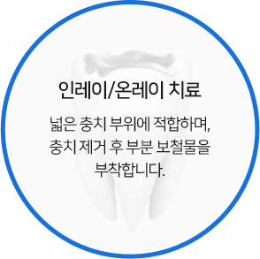 인레이/온레이 치료