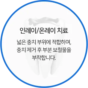 인레이/온레이 치료