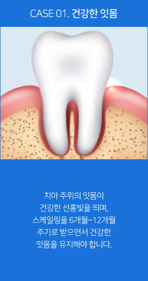 건강한 잇몸