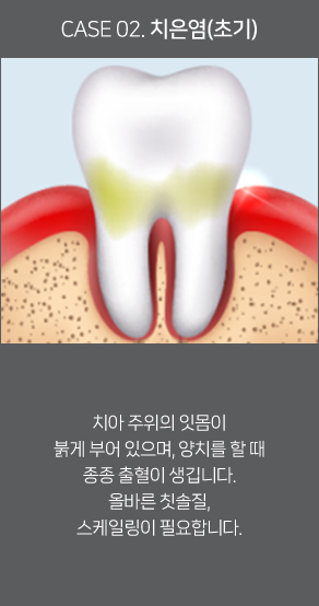 치은염(초기)