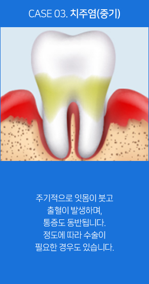 치주염(중기)