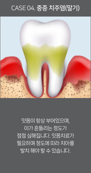 치주염(말기)