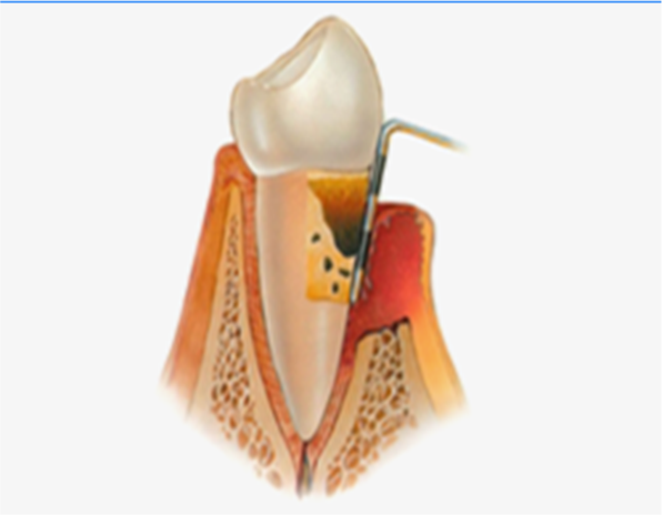 잇몸수술 (치은박리소파술)