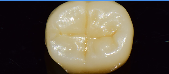 보철물 부착지르코니아 밀링 및 후가공