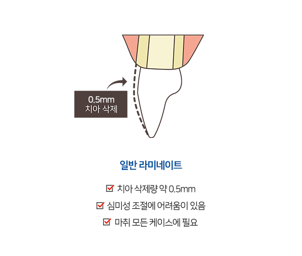 무삭제/최소삭제 라미네이트