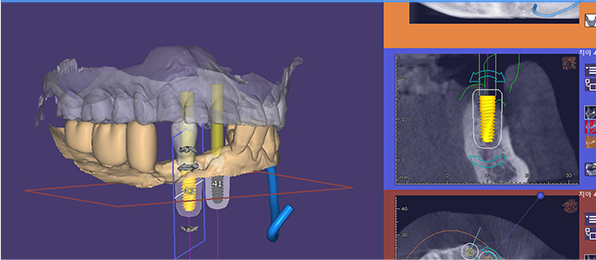 임플란트 삽입 배열 디자인 