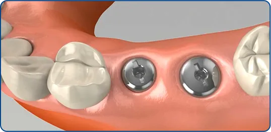 치유기간