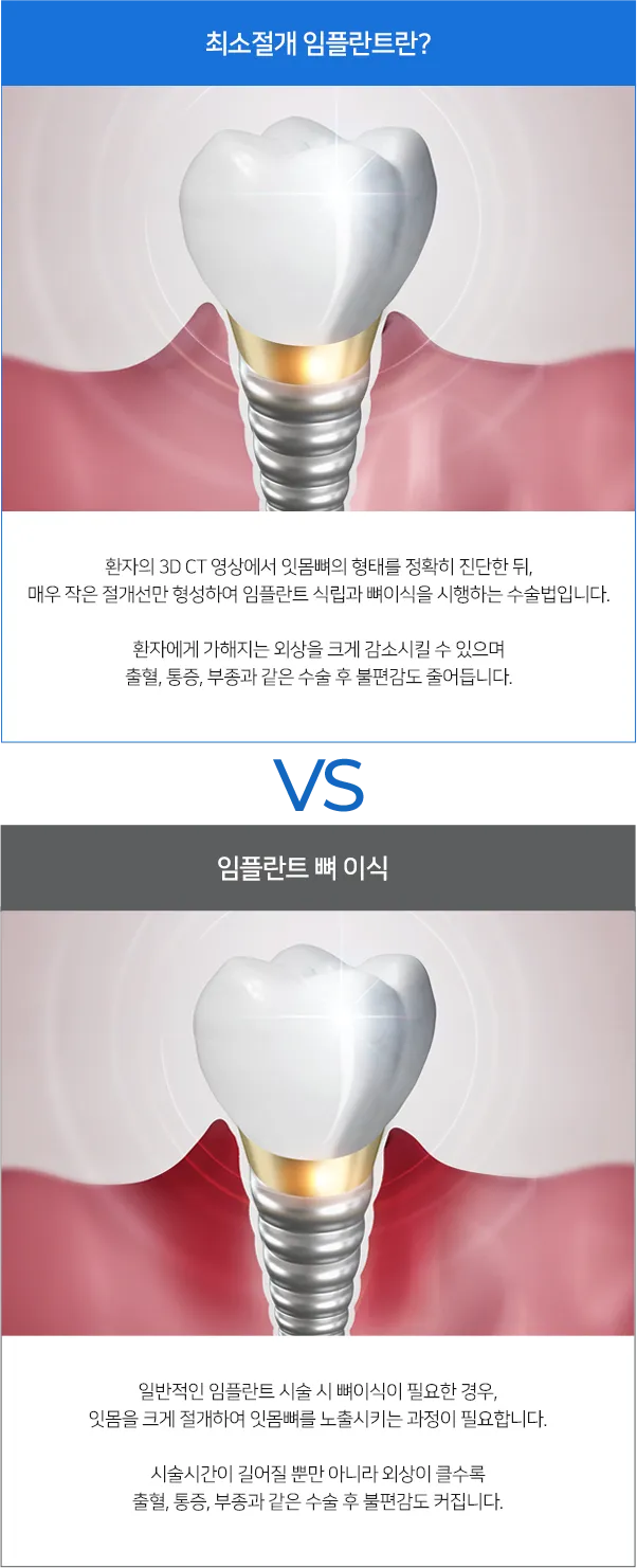 최소절개 임플란트 전후