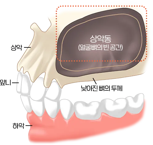 상악동 구조