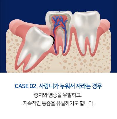 사랑니발치